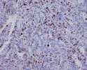 Survivin antibody immunohistochemistry human ovarian cancer STJA0035937