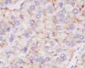 LAMP2a antibody immunohistochemistry human liver cancer STJA0035947