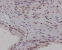 PIM1 antibody immunohistochemistry human prostate carcinoma STJA0035962
