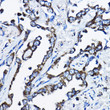 Immunohistochemistry analysis of paraffin-embedded Human lung cancer using MSRB2 Rabbit pAb (STJ110662) at dilution of 1:200 (40x lens). High pressure antigen retrieval performed with 0. 01M Citrate Bufferr (pH 6. 0) prior to immunohistochemistry staining.