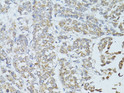 Immunohistochemistry analysis of paraffin-embedded Human colon carcinoma using TEFM Rabbit pAb (STJ110809) at dilution of 1:100 (40x lens). Microwave antigen retrieval performed with 0. 01M PBS Buffer (pH 7. 2) prior to immunohistochemistry staining.