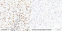 Immunohistochemistry analysis of paraffin-embedded Human liver tissue using Phospho-IRS1-S307 (Human Specific) Rabbit pAb (STJ110879) at a dilution of 1:1600 (40x lens). High pressure antigen retrieval performed with 0. 01M Citrate Buffer (pH 6. 0) prior to immunohistochemistry staining.
