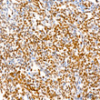 Immunohistochemistry analysis of FGF2 in paraffin-embedded human lung squamous carcinoma tissue using FGF2 Rabbit monoclonal antibody (STJ11101344) at dilution of 1:400 (40x lens). Perform high pressure antigen retrieval with 10 mM Tris/EDTA buffer pH 9. 0 before commencing with immunohistochemistry staining protocol.