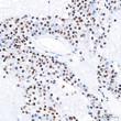 Immunohistochemistry analysis of PABPN1 in paraffin-embedded human liver cancer tissue using PABPN1 rabbit monoclonal antibody (STJ11101447) at a dilution of 1:200 (40x lens). High pressure antigen retrieval was performed with 0. 01 M citrate buffer (pH 6. 0) prior to immunohistochemistry staining.