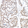 Immunohistochemistry analysis of PABPN1 in paraffin-embedded human lung squamous carcinoma tissue tissue using PABPN1 rabbit monoclonal antibody (STJ11101447) at a dilution of 1:200 (40x lens). High pressure antigen retrieval was performed with 0. 01 M citrate buffer (pH 6. 0) prior to immunohistochemistry staining.