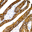 Immunohistochemistry analysis of Cytokeratin 19 (CK19) in paraffin-embedded human colon carcinoma using Cytokeratin 19 (CK19) Rabbit monoclonal antibody (STJ11101578) at dilution of 1:20 (40x lens). Perform high pressure antigen retrieval with 10 mM citrate buffer pH 6. 0 before commencing with immunohistochemistry staining protocol.
