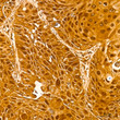Immunohistochemistry analysis of paraffin-embedded human lung squamous carcinoma tissue using GST3/GSTP1 rabbit monoclonal antibody (STJ11101599) at dilution of 1:200 (40x lens). Perform high pressure antigen retrieval with 10 mM citrate buffer pH 6. 0 before commencing with immunohistochemistry staining protocol.