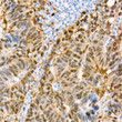 Immunohistochemistry analysis of paraffin-embedded Human colon carcinoma using YAP1 antibody (STJ11101671) at dilution of 1:200 (40x lens). Perform high pressure antigen retrieval with 10 mM citrate buffer pH 6. 0 before commencing with immunohistochemistry staining protocol.