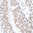Immunohistochemistry analysis of HP1 alpha/CBX5 in paraffin-embedded human lung cancer tissue using HP1 alpha/CBX5 rabbit monoclonal antibody (STJ11101944) at a dilution of 1:200 (40x lens). High pressure antigen retrieval was performed with 0. 01 M citrate buffer (pH 6. 0) prior to immunohistochemistry staining.