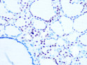 Immunohistochemistry analysis of Histone H1. 0 in paraffin-embedded human thyroid cancer using Histone H1. 0 Rabbit monoclonal antibody (STJ11102045) at dilution of 1:100 (40x lens). Perform microwave antigen retrieval with 10 mM PBS buffer pH 7. 2 before commencing with immunohistochemistry staining protocol.