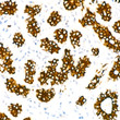 Immunohistochemistry analysis of paraffin-embedded human breast using Cytokeratin 7 (KRT7) rabbit monoclonal antibody (STJ11102055) at dilution of 1:100 (40x lens). Perform microwave antigen retrieval with 10 mM PBS buffer pH 7. 2 before commencing with immunohistochemistry staining protocol.