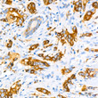 Immunohistochemistry analysis of paraffin-embedded human breast cancer using Stathmin 1 rabbit monoclonal antibody (STJ11102063) at dilution of 1:200 (40x lens). Perform high pressure antigen retrieval with 10 mM citrate buffer pH 6. 0 before commencing with immunohistochemistry staining protocol.