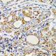 Immunohistochemistry analysis of paraffin-embedded Human colon carcinoma tissue using NDUFS4 Rabbit mAb  (STJ11102353) at a dilution of 1:400 (40x lens).  High pressure antigen retrieval was performed with 0. 01 M citrate buffer (pH 6. 0) prior to immunohistochemistry staining.