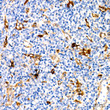 Immunohistochemistry analysis of paraffin-embedded Human anaplastic large cell lymphoma using Fascin/FSCN1 Rabbit mAb (STJ11102495) at dilution of 1:100 (40x lens). Microwave antigen retrieval performed with 0. 01M Tris/EDTA Buffer (pH 9. 0) prior to immunohistochemistry staining.