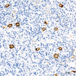 Immunohistochemistry analysis of paraffin-embedded Human Hodgkin lymphoma using Fascin/FSCN1 Rabbit mAb (STJ11102495) at dilution of 1:100 (40x lens). Microwave antigen retrieval performed with 0. 01M Tris/EDTA Buffer (pH 9. 0) prior to immunohistochemistry staining.