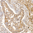 Immunohistochemistry analysis of paraffin-embedded Human lung cancer using NUMB Rabbit pAb (STJ111671) at dilution of 1:100 (40x lens). High pressure antigen retrieval performed with 0. 01M Citrate Bufferr (pH 6. 0) prior to immunohistochemistry staining.