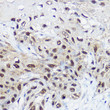 Immunohistochemistry analysis of paraffin-embedded human esophageal cancer using SMARCA1 rabbit polyclonal antibody (STJ112286) at dilution of 1:100 (40x lens). Perform high pressure antigen retrieval with 10 mM citrate buffer pH 6. 0 before commencing with immunohistochemistry staining protocol.