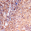 Immunohistochemistry analysis of Bcl-2 in paraffin-embedded human tonsil tissue using Bcl-2 Rabbit polyclonal antibody (STJ113759) at a dilution of 1:200 (40x lens). Microwave antigen retrieval was performed with 0. 01 M PBS buffer (pH 7. 2±0. 2) prior to immunohistochemistry staining.