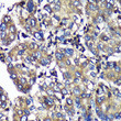 Immunohistochemistry analysis of SENP1 in paraffin-embedded Human liver cancer using SENP1 Rabbit polyclonal antibody (STJ115053) at dilution of 1:100 (40x lens). Perform microwave antigen retrieval with 10 mM PBS buffer pH 7. 2 before commencing with immunohistochemistry staining protocol.