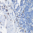 Immunohistochemistry analysis of paraffin-embedded human colon carcinoma using STK19 Rabbit polyclonal antibody (STJ115345) at dilution of 1:100 (40x lens). Perform high pressure antigen retrieval with 10 mM citrate buffer pH 6. 0 before commencing with immunohistochemistry staining protocol.