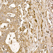 Immunohistochemistry analysis of paraffin-embedded human colon carcinoma using P23/PTGES3 Rabbit polyclonal antibody (STJ115361) at dilution of 1:200 (40x lens). Perform high pressure antigen retrieval with 10 mM citrate buffer pH 6. 0 before commencing with immunohistochemistry staining protocol.