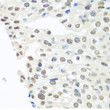 Immunohistochemistry analysis of TDP-43/TARDB in paraffin-embedded human prostate cancer using TDP-43/TARDB Rabbit polyclonal antibody (STJ115367) at dilution of 1:100 (40x lens). Perform microwave antigen retrieval with 10 mM PBS buffer pH 7. 2 before commencing with immunohistochemistry staining protocol.