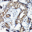 Immunohistochemistry analysis of SUFU in paraffin-embedded human breast cancer using SUFU Rabbit polyclonal antibody (STJ115390) at dilution of 1:100 (40x lens). Perform high pressure antigen retrieval with 10 mM citrate buffer pH 6. 0 before commencing with immunohistochemistry staining protocol.