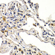 Immunohistochemistry analysis of paraffin-embedded human lung cancer using WNT3A antibody (STJ115562) at dilution of 1:200 (40x lens). Perform microwave antigen retrieval with 10 mM PBS buffer pH 7. 2 before commencing with immunohistochemistry staining protocol.