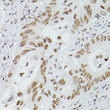 Immunohistochemistry analysis of GATA4 in paraffin-embedded human colon carcinoma using GATA4 Rabbit polyclonal antibody (STJ115704) at dilution of 1:100 (40x lens). Perform high pressure antigen retrieval with 10 mM citrate buffer pH 6. 0 before commencing with immunohistochemistry staining protocol.