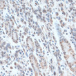 Immunohistochemistry analysis of paraffin-embedded Human gastric cancer using ZNF707 Rabbit pAb (STJ116423) at dilution of 1:100 (40x lens). Microwave antigen retrieval performed with 0. 01M PBS Buffer (pH 7. 2) prior to immunohistochemistry staining.