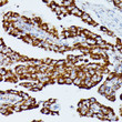 Immunohistochemistry analysis of IDH3A in paraffin-embedded human thyroid cancer using IDH3A Rabbit polyclonal antibody (STJ116856) at dilution of 1:100 (40x lens). Perform microwave antigen retrieval with 10 mM PBS buffer pH 7. 2 before commencing with immunohistochemistry staining protocol.