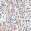 Immunohistochemistry analysis of ZNF562 in paraffin-embedded human gastric cancer using ZNF562 Rabbit polyclonal antibody (STJ117101) at dilution of 1:100 (40x lens). Perform microwave antigen retrieval with 10 mM PBS buffer pH 7. 2 before commencing with immunohistochemistry staining protocol. Immunohistochemistry analysis of ZNF562 in paraffin-embedded human gastric cancer using ZNF562 Rabbit polyclonal antibody (STJ117101) at dilution of 1:100 (40x lens). Perform microwave antigen retrieval with 10 mM PBS buffer pH 7. 2 before commencing with immunohistochemistry staining protocol.