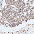 Immunohistochemistry analysis of ZNF562 in paraffin-embedded human lung cancer using ZNF562 Rabbit polyclonal antibody (STJ117101) at dilution of 1:100 (40x lens). Perform microwave antigen retrieval with 10 mM PBS buffer pH 7. 2 before commencing with immunohistochemistry staining protocol. Immunohistochemistry analysis of ZNF562 in paraffin-embedded human lung cancer using ZNF562 Rabbit polyclonal antibody (STJ117101) at dilution of 1:100 (40x lens). Perform microwave antigen retrieval with 10 mM PBS buffer pH 7. 2 before commencing with immunohistochemistry staining protocol.