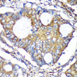 Immunohistochemistry analysis of ACTR1B in paraffin-embedded Human colon carcinoma using ACTR1B Rabbit polyclonal antibody (STJ118218) at dilution of 1:100 (40x lens). Perform microwave antigen retrieval with 10 mM PBS buffer pH 7. 2 before commencing with immunohistochemistry staining protocol.
