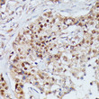Immunohistochemistry analysis of IGHMBP2 in paraffin-embedded human mammary cancer using IGHMBP2 Rabbit polyclonal antibody (STJ118494) at dilution of 1:100 (40x lens). Perform microwave antigen retrieval with 10 mM PBS buffer pH 7. 2 before commencing with immunohistochemistry staining protocol.