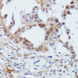 Immunohistochemistry analysis of IGHMBP2 in paraffin-embedded human lung cancer using IGHMBP2 Rabbit polyclonal antibody (STJ118494) at dilution of 1:100 (40x lens). Perform microwave antigen retrieval with 10 mM PBS buffer pH 7. 2 before commencing with immunohistochemistry staining protocol.