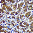 Immunohistochemistry analysis of CTNNA3 in paraffin-embedded Human liver cancer using CTNNA3 Rabbit polyclonal antibody (STJ118946) at dilution of 1:100 (40x lens). Perform microwave antigen retrieval with 10 mM PBS buffer pH 7. 2 before commencing with immunohistochemistry staining protocol.