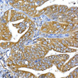 Immunohistochemistry analysis of IRS1 in paraffin-embedded human lung cancer tissue using IRS1 Rabbit polyclonal antibody (STJ119225) at a dilution of 1:100 (40x lens). High pressure antigen retrieval was performed with 0. 01 M citrate buffer (pH 6. 0) prior to immunohistochemistry staining.