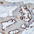 Immunohistochemistry analysis of CEACAM1 in paraffin-embedded human colon carcinoma using CEACAM1 Rabbit polyclonal antibody (STJ23089) at dilution of 1:100 (40x lens). Perform high pressure antigen retrieval with 10 mM citrate buffer pH 6. 0 before commencing with immunohistochemistry staining protocol.