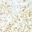 Immunohistochemistry analysis of paraffin-embedded human liver cancer using DKC1 Antibody (STJ23384) at dilution of 1:200 (40x lens). Perform microwave antigen retrieval with 10 mM PBS buffer pH 7. 2 before commencing with immunohistochemistry staining protocol.