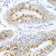 Immunohistochemistry analysis of paraffin-embedded human colon carcinoma using FAM3B antibody (STJ23622) at dilution of 1:100 (40x lens). Perform microwave antigen retrieval with 10 mM PBS buffer pH 7. 2 before commencing with immunohistochemistry staining protocol.
