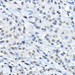 Immunohistochemistry analysis of paraffin-embedded human breast cancer using MonoMethyl-Histone H3-K27 rabbit polyclonal antibody (STJ23987) at dilution of 1:100 (40x lens). Perform high pressure antigen retrieval with 10 mM citrate buffer pH 6. 0 before commencing with immunohistochemistry staining protocol.