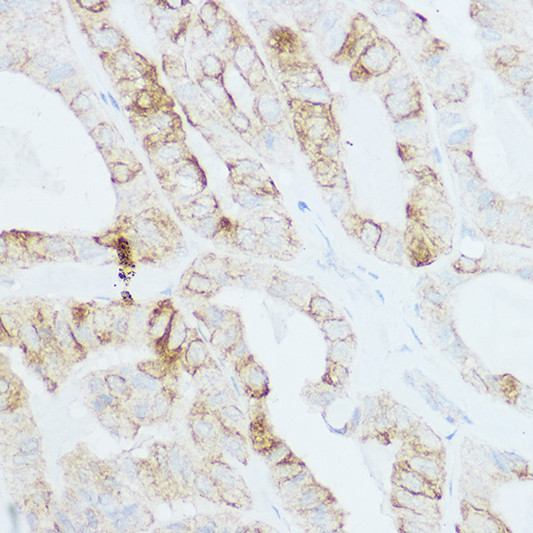 Immunohistochemistry analysis of paraffin-embedded human thyroid cancer using TSHR Rabbit polyclonal antibody (STJ28864) at dilution of 1:200 (40x lens). Perform high pressure antigen retrieval with 10 mM citrate buffer pH 6. 0 before commencing with immunohistochemistry staining protocol.