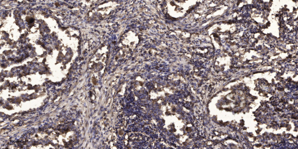 Immunohistochemical analysis of paraffin-embedded human Squamous cell carcinoma of lung. 1, Antibody was diluted at 1:200 (4°C overnight). 2, Tris-EDTA, pH9.0 was used for antigen retrieval. 3, Secondary antibody was diluted at 1:200 (room temperature, 45min).