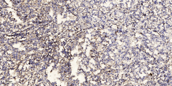 Immunohistochemical analysis of paraffin-embedded human Squamous cell carcinoma of lung. 1, Antibody was diluted at 1:200 (4°C overnight). 2, Tris-EDTA, pH9.0 was used for antigen retrieval. 3, Secondary antibody was diluted at 1:200 (room temperature, 45min).