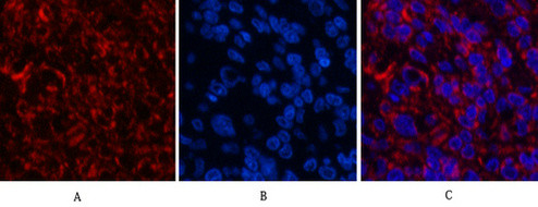 Immunofluorescence analysis of Human-lung-cancer tissue. 1, Cleaved-Caspase-3 p12 (D175) Polyclonal Antibody (red) was diluted at 1:200 (4°C, overnight). 2, Cy3 labled Secondary antibody was diluted at 1:300 (room temperature, 50min).3, Picture B: DAPI (blue) 10min. Picture A:Target. Picture B: DAPI. Picture C: merge of A+B