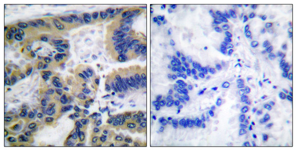 Immunohistochemistry analysis of paraffin-embedded human lung carcinoma tissue, using Caspase 7 (Cleaved-Asp198) Antibody. The picture on the right is blocked with the synthesized peptide.