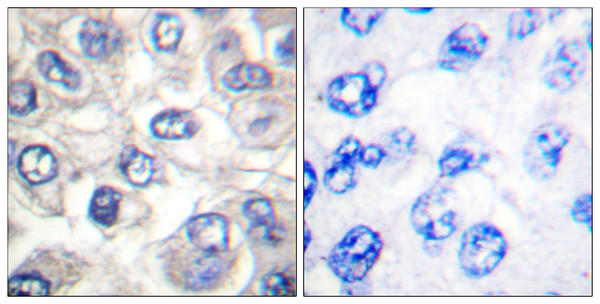 Immunohistochemistry analysis of paraffin-embedded human breast carcinoma tissue, using BAD (Cleaved-Asp71) Antibody. The picture on the right is blocked with the synthesized peptide.