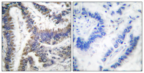 Immunohistochemistry analysis of paraffin-embedded human lung carcinoma, using DFF45 (Cleaved-Asp224) Antibody. The picture on the right is blocked with the synthesized peptide.