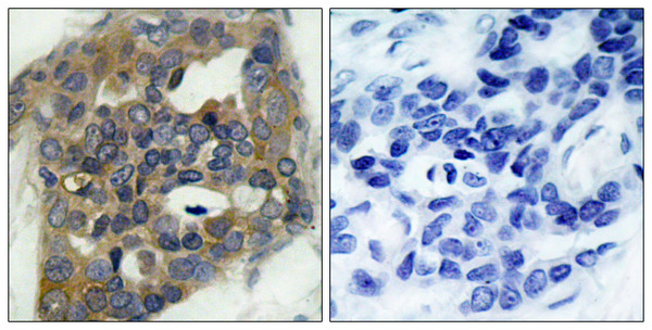 Immunohistochemistry analysis of paraffin-embedded human breast carcinoma, using ASK1 (Phospho-Ser966) Antibody. The picture on the right is blocked with the phospho peptide.